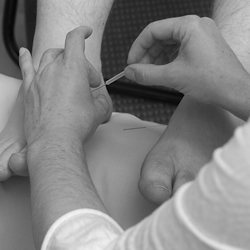 Dana Balassi placing an acupuncture needle at Dragonfly Holistic Healing in Fremont, Seattle, Washington